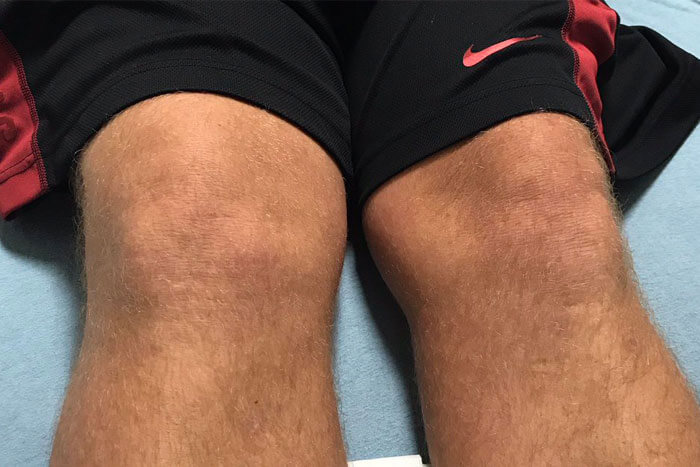 John Daly Knee Injury