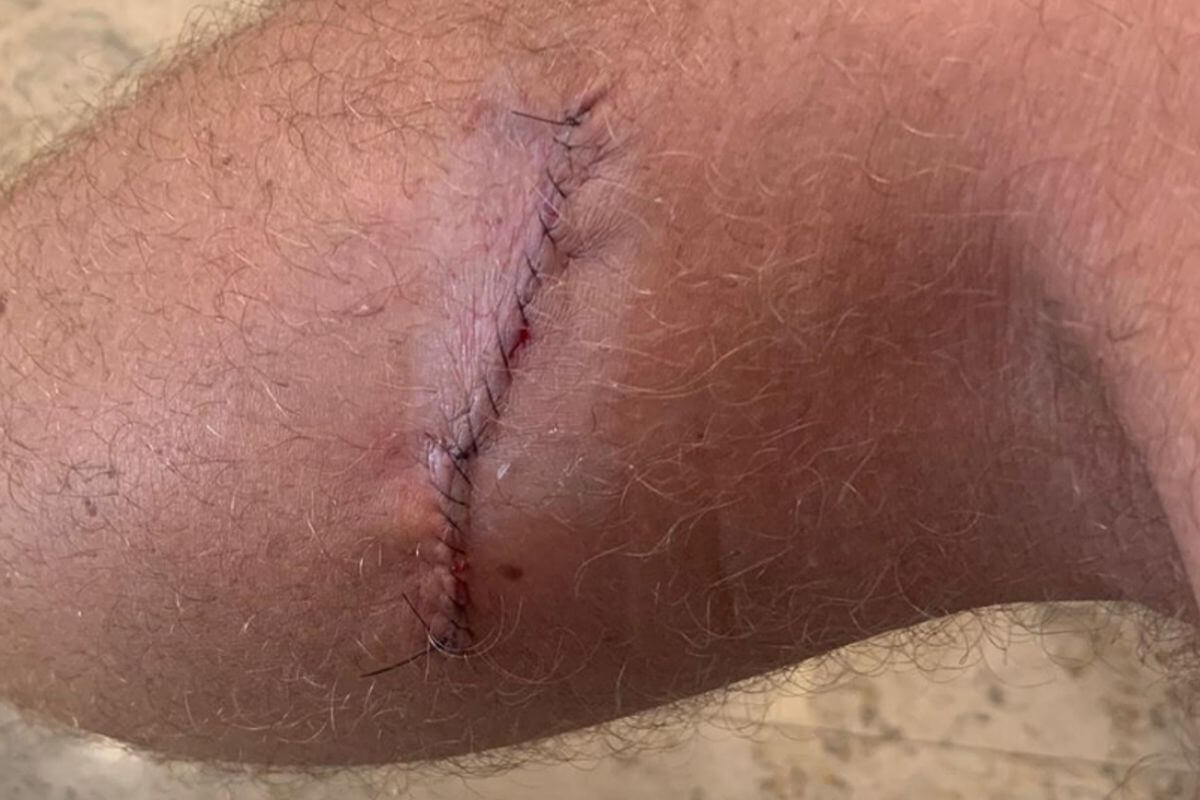 Justin Thomas Melanoma